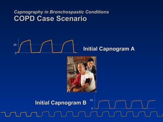 Capnography in Bronchospastic Conditions COPD Case Scenario Initial Capnogram A Initial Capnogram B 4 5 0 