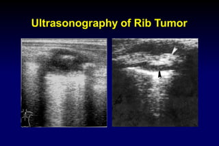 Ultrasound For Rib Example 03 chest ultrasound | PDF