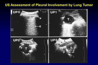 03 chest ultrasound | PDF