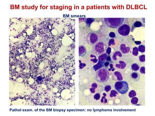 BM study for staging in a patients with DLBCL
Pathol exam. of the BM biopsy specimen: no lymphoma involvement
BM smears
 