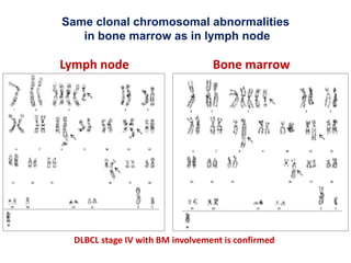 Same clonal chromosomal abnormalities
in bone marrow as in lymph node
Lymph node Bone marrow
DLBCL stage IV with BM involvement is confirmed
 