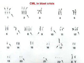 CML in blast crisis
 