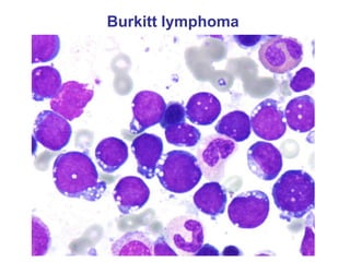 Burkitt lymphoma
 
