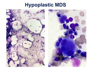 Hypoplastic MDS
 