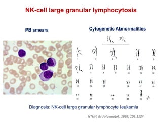 NK-cell large granular lymphocytosis
NTUH, Br J Haematol, 1998, 103:1124
Cytogenetic Abnormalities
Diagnosis: NK-cell large granular lymphocyte leukemia
PB smears
 