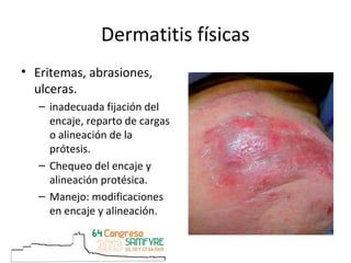 Dermatitis físicas
• Eritemas, abrasiones,
ulceras.
– inadecuada fijación del
encaje, reparto de cargas
o alineación de la...