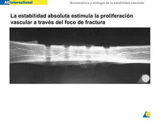 Biomecánica y biología de la estabilidad absoluta
La estabilidad absoluta estimula la proliferación
vascular a través del foco de fractura
 
