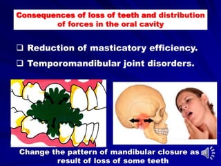 Consequences of loss of teeth and distribution
of forces in the oral cavity
Change the pattern of mandibular closure as a
result of loss of some teeth
 Reduction of masticatory efficiency.
 Temporomandibular joint disorders.
 