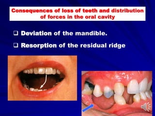 Consequences of loss of teeth and distribution
of forces in the oral cavity
 Deviation of the mandible.
 Resorption of the residual ridge
 