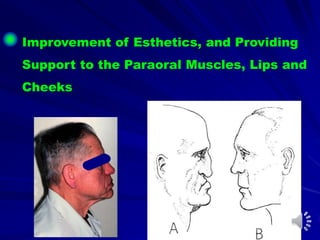 Improvement of Esthetics, and Providing
Support to the Paraoral Muscles, Lips and
Cheeks
 
