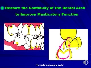 Normal masticatory cycle
Restore the Continuity of the Dental Arch
to Improve Masticatory Function
 