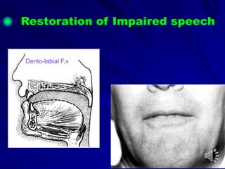 Restoration of Impaired speech
Dento-labial F,v
 