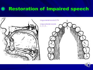 Linguo-dental sounds S,TH
Linguo-alveolar sounds
L, n, t, d....
Restoration of Impaired speech
 