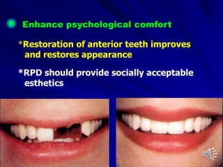 Enhance psychological comfort
*Restoration of anterior teeth improves
and restores appearance
*RPD should provide socially acceptable
esthetics
 
