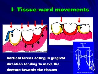 Vertical forces acting in gingival
direction tending to move the
denture towards the tissues
I- Tissue-ward movements
Control direction of force
 