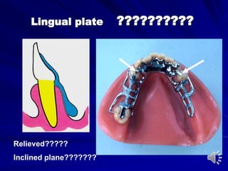 Lingual plate ??????????
Relieved?????
Inclined plane???????
 