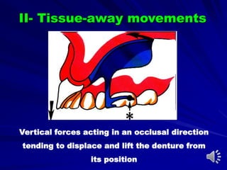 II- Tissue-away movements
Vertical forces acting in an occlusal direction
tending to displace and lift the denture from
its position
 