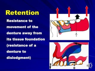 Resistance to
movement of the
denture away from
its tissue foundation
(resistance of a
denture to
dislodgment)
Retention
 