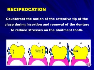Counteract the action of the retentive tip of the
clasp during insertion and removal of the denture
to reduce stresses on the abutment tooth.
RECIPROCATION
Retentive
distance
 