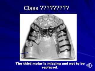 Class ?????????
The third molar is missing and not to be
replaced.
 