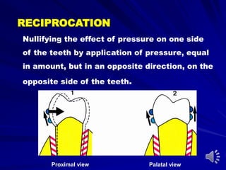 Palatal viewProximal view
RECIPROCATION
Nullifying the effect of pressure on one side
of the teeth by application of pressure, equal
in amount, but in an opposite direction, on the
opposite side of the teeth.
 