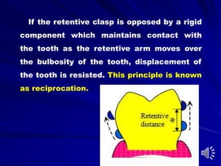If the retentive clasp is opposed by a rigid
component which maintains contact with
the tooth as the retentive arm moves over
the bulbosity of the tooth, displacement of
the tooth is resisted. This principle is known
as reciprocation.
 