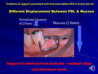Periodontal ligament
(0.25mm) Mucosa (2.0mm)
Different Displacement Between PDL & Mucosa
Support is derived from both the residual ridge
and abutment teeth
Problems of support associated with free-end saddles RPD is mainly due to:
 