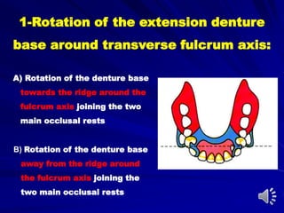 1-Rotation of the extension denture
base around transverse fulcrum axis:
A) Rotation of the denture base
towards the ridge around the
fulcrum axis joining the two
main occlusal rests
B) Rotation of the denture base
away from the ridge around
the fulcrum axis joining the
two main occlusal rests
 