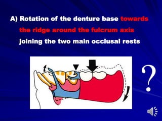 A) Rotation of the denture base towards
the ridge around the fulcrum axis
joining the two main occlusal rests
?
 