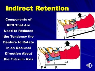Components of
RPD That Are
Used to Reduces
the Tendency the
Denture to Rotate
in an Occlusal
Direction About
the Fulcrum Axis
Indirect Retention
 