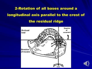 2-Rotation of all bases around a
longitudinal axis parallel to the crest of
the residual ridge
 