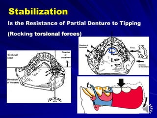 Stabilization
Is the Resistance of Partial Denture to Tipping
(Rocking torsional forces)
 
