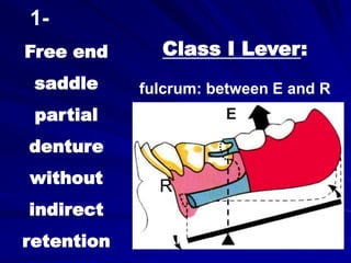 Class I Lever:
fulcrum: between E and R
R
Free end
saddle
partial
denture
without
indirect
retention
1-
E
 