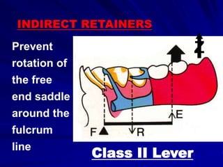 Prevent
rotation of
the free
end saddle
around the
fulcrum
line
INDIRECT RETAINERS
Z
Class II Lever
 