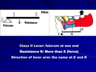 Class II Lever: fulcrum at one end
Resistance R: More than E (force)
Direction of lever arm: the same at E and R
 