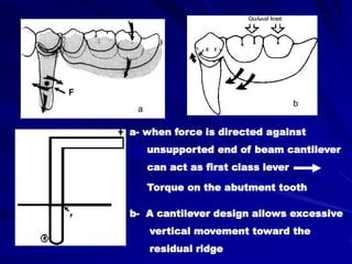 a- when force is directed against
unsupported end of beam cantilever
can act as first class lever
Torque on the abutment tooth
F
b- A cantilever design allows excessive
vertical movement toward the
residual ridge
a
b
 