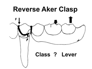 Reverse Aker Clasp
F
Class ? Lever
 