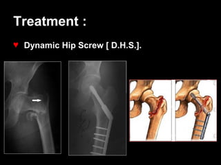 Dhs Radiopaedia Fracture of Lower Limb and Pelvis | PPT