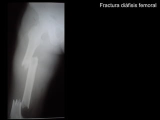 Fractura diáfisis femoral
 