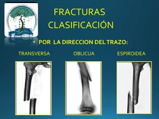 FRACTURAS
CLASIFICACIÓN
• POR LA DIRECCION DELTRAZO:
TRANSVERSA OBLICUA ESPIROIDEA
 