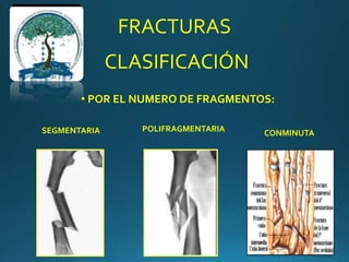 FRACTURAS
CLASIFICACIÓN
• POR EL NUMERO DE FRAGMENTOS:
POLIFRAGMENTARIASEGMENTARIA CONMINUTA
 