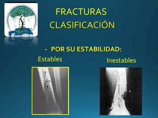 FRACTURAS
CLASIFICACIÓN
• POR SU ESTABILIDAD:
Estables Inestables
 
