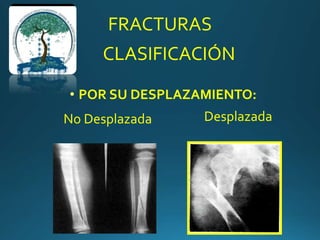 FRACTURAS
CLASIFICACIÓN
• POR SU DESPLAZAMIENTO:
No Desplazada Desplazada
 
