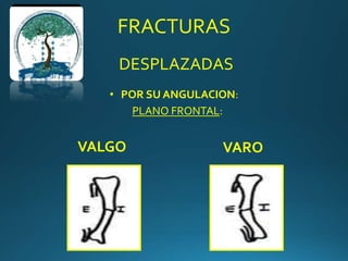 FRACTURAS
DESPLAZADAS
• POR SU ANGULACION:
PLANO FRONTAL:
VALGO VARO
 