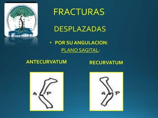 FRACTURAS
DESPLAZADAS
• POR SU ANGULACION:
PLANO SAGITAL:
ANTECURVATUM RECURVATUM
 