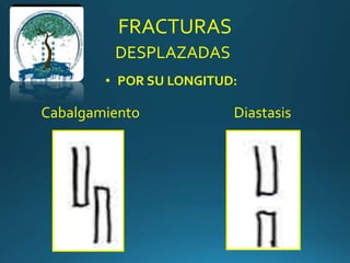 FRACTURAS
DESPLAZADAS
• POR SU LONGITUD:
Cabalgamiento Diastasis
 