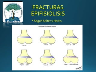 FRACTURAS
EPIFISIOLISIS
• Según Salter y Harris:
 