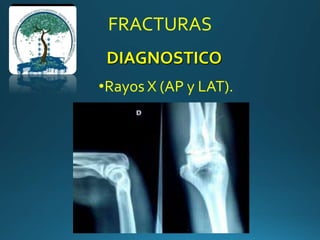 •Rayos X (AP y LAT).
DIAGNOSTICO
FRACTURAS
 