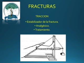 FRACTURAS
TRACCION
• Estabilizador de la fractura.
• Analgésico.
• Tratamiento.
 