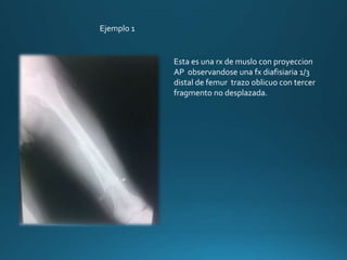 Ejemplo 1
Esta es una rx de muslo con proyeccion
AP observandose una fx diafisiaria 1/3
distal de femur trazo oblicuo con tercer
fragmento no desplazada.
 